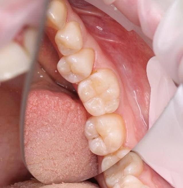Состояние зубов 2.1 и 2.2 после реставрации