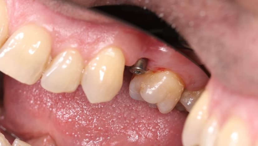 Прямые до реставрации зуба 4.6