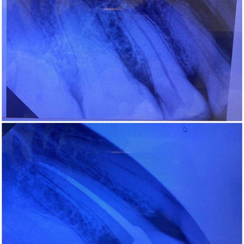 Состояние зубов 2.1 и 2.2 после реставрации