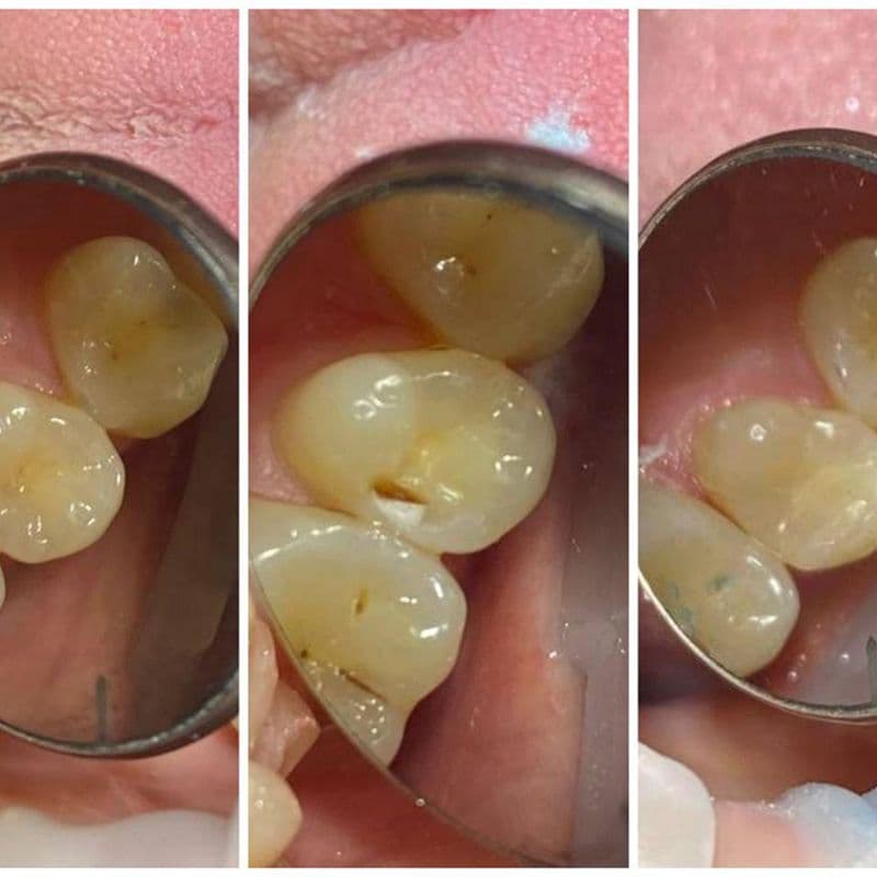 Прямые до реставрации зуба 4.6