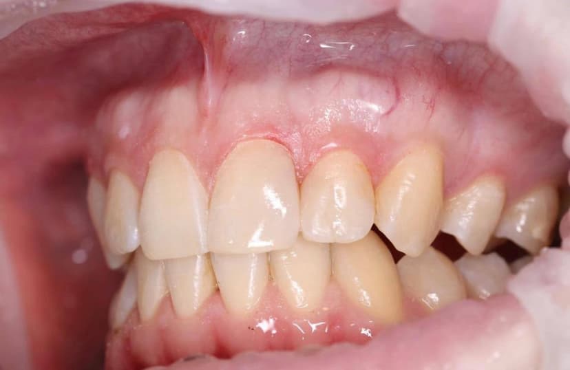 Состояние зубов 2.1 и 2.2 после реставрации