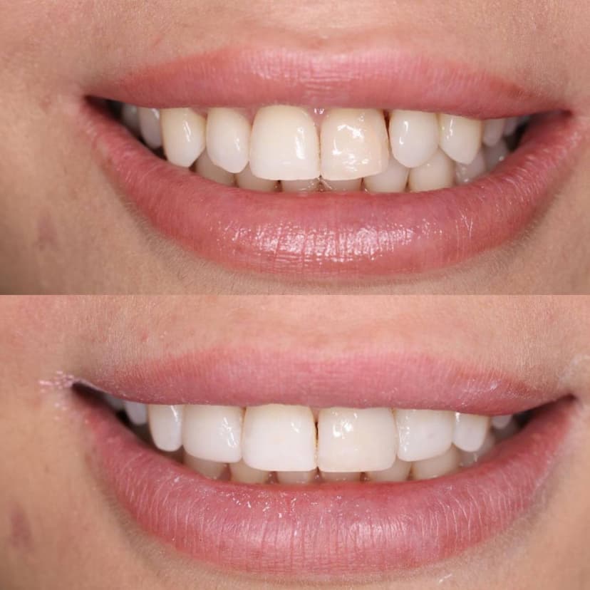 Состояние зубов 2.1 и 2.2 до реставрации