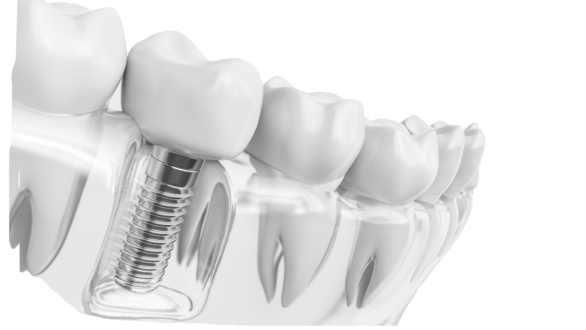Исправление прикуса