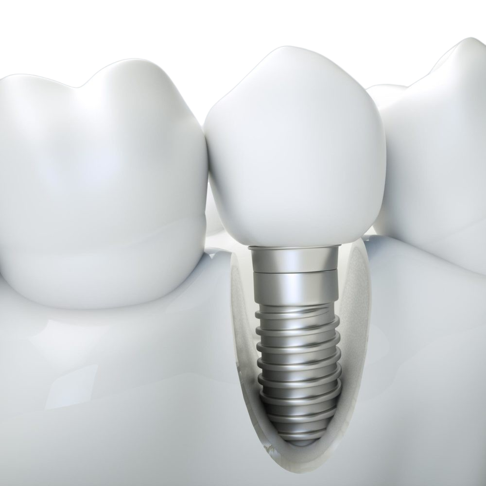 Отбеливание зубов