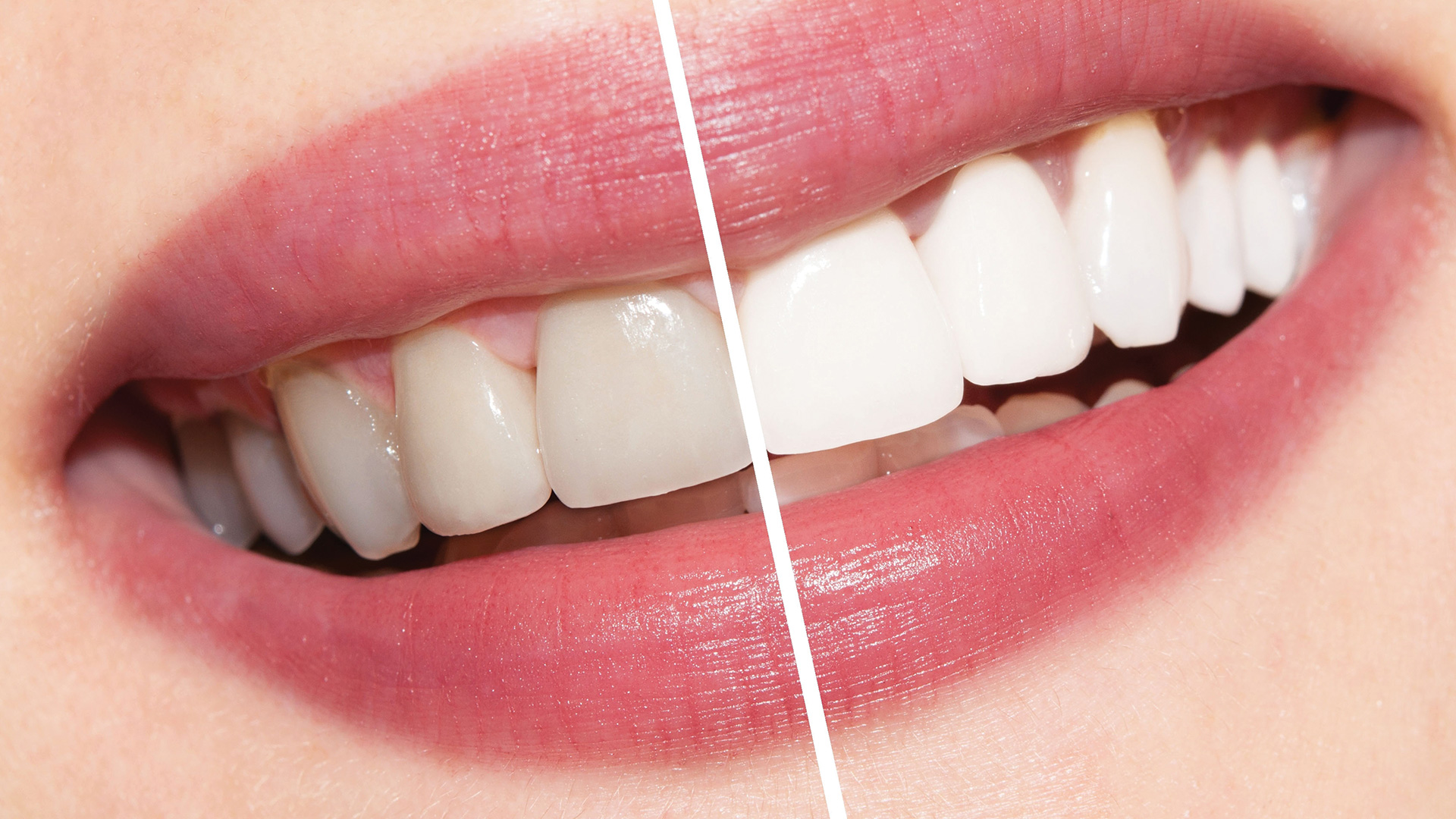 Отбеливание зубов